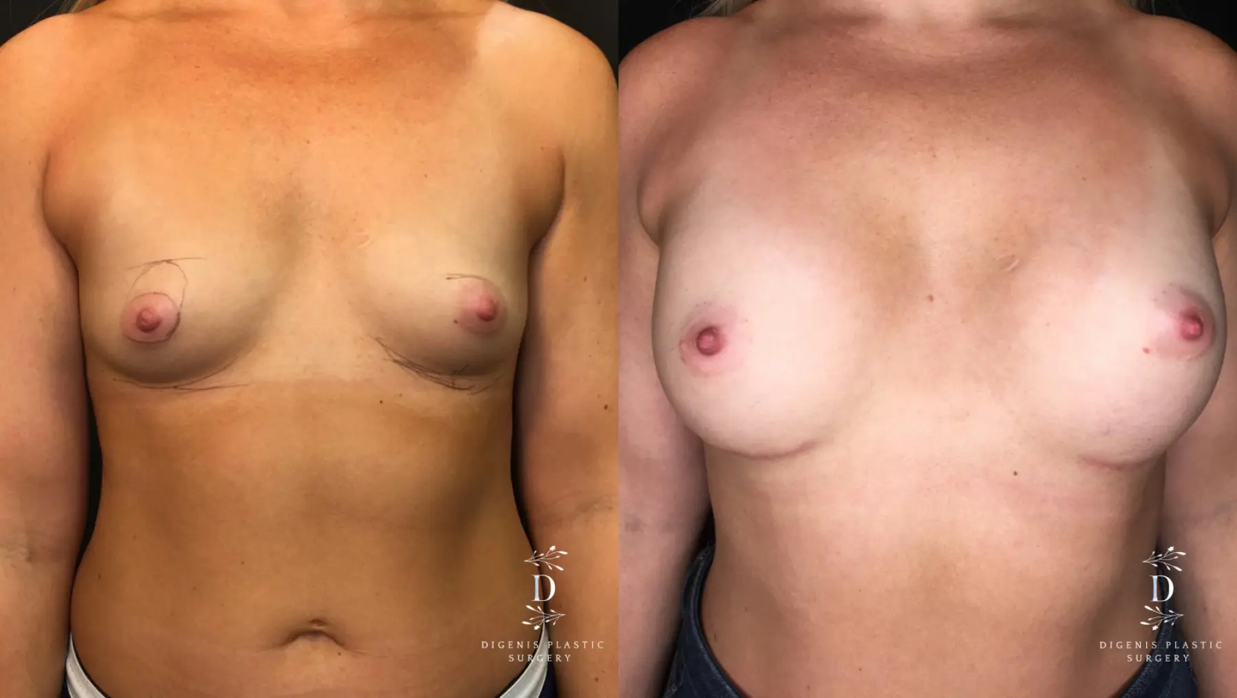 Breast Augmentation: Patient 19 - Before and After 1