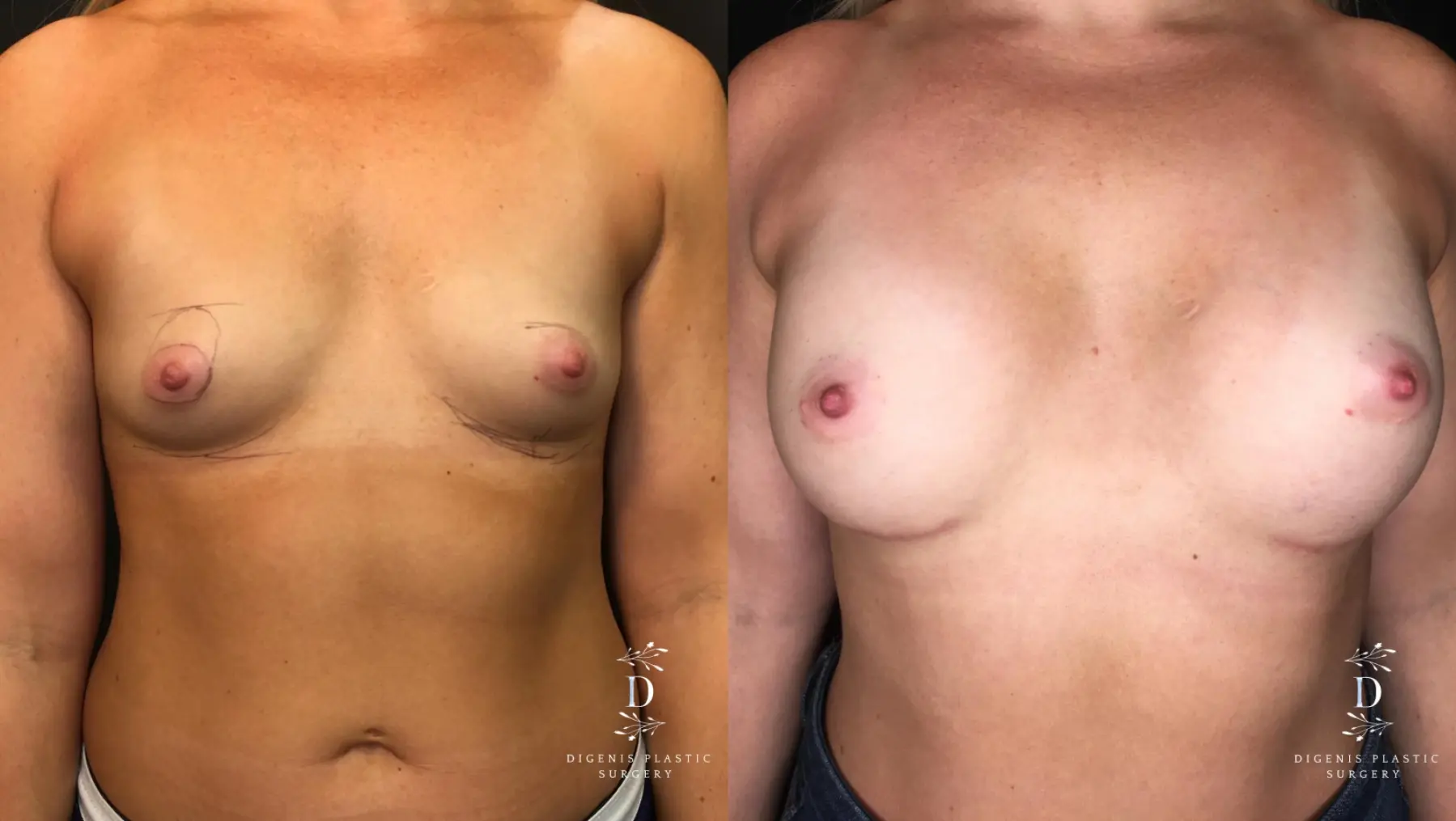 Breast Augmentation: Patient 19 - Before and After  