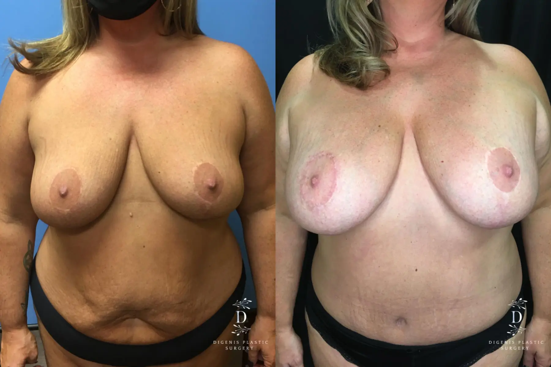 Breast Augmentation: Patient 17 - Before and After  