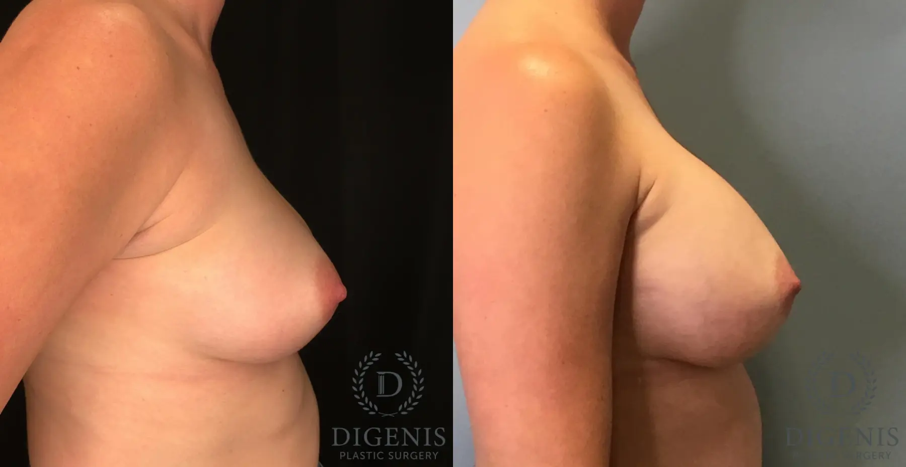 Breast Augmentation: Patient 30 - Before and After 3