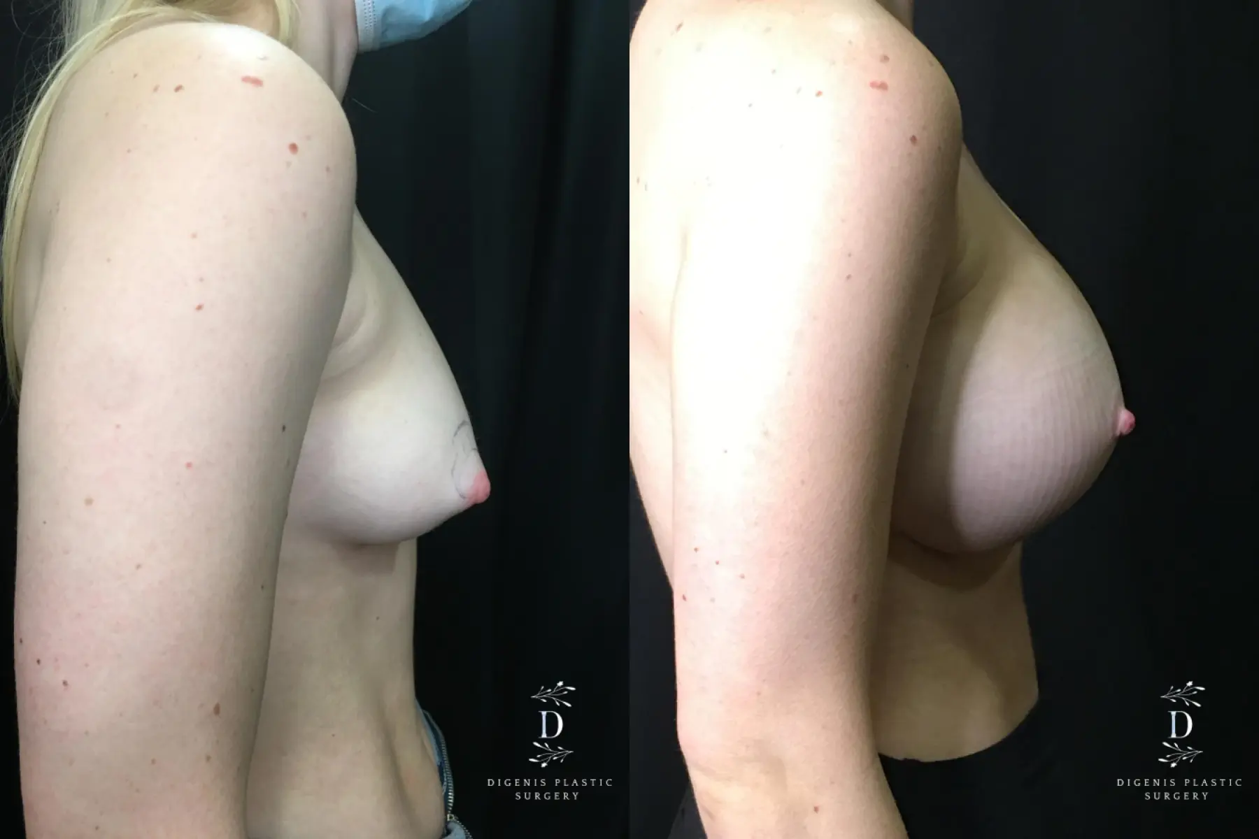 Breast Augmentation: Patient 23 - Before and After 3