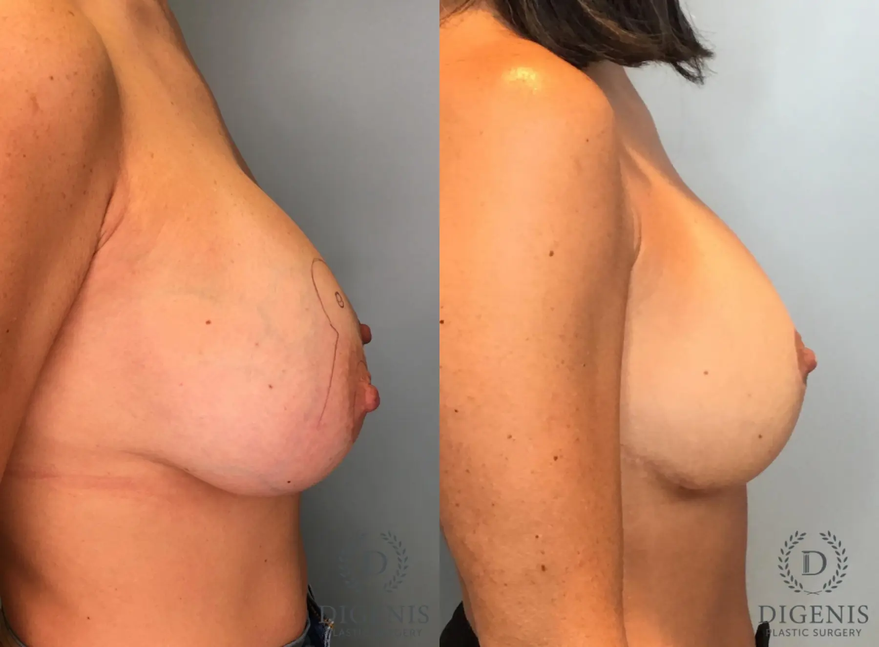Breast Augmentation: Patient 32 - Before and After 5