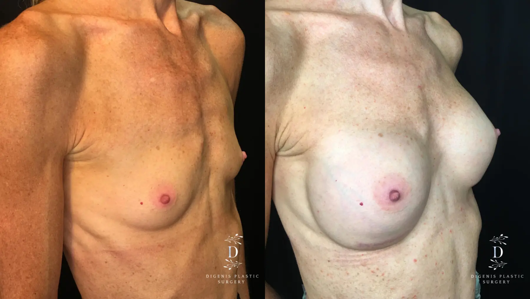 Breast Augmentation: Patient 20 - Before and After 2