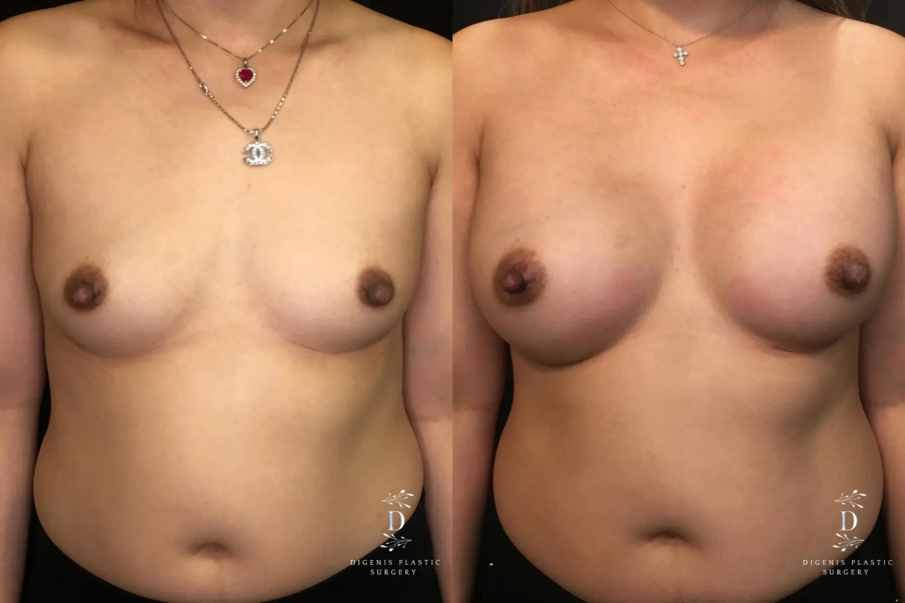 Breast Augmentation: Patient 18 - Before and After  