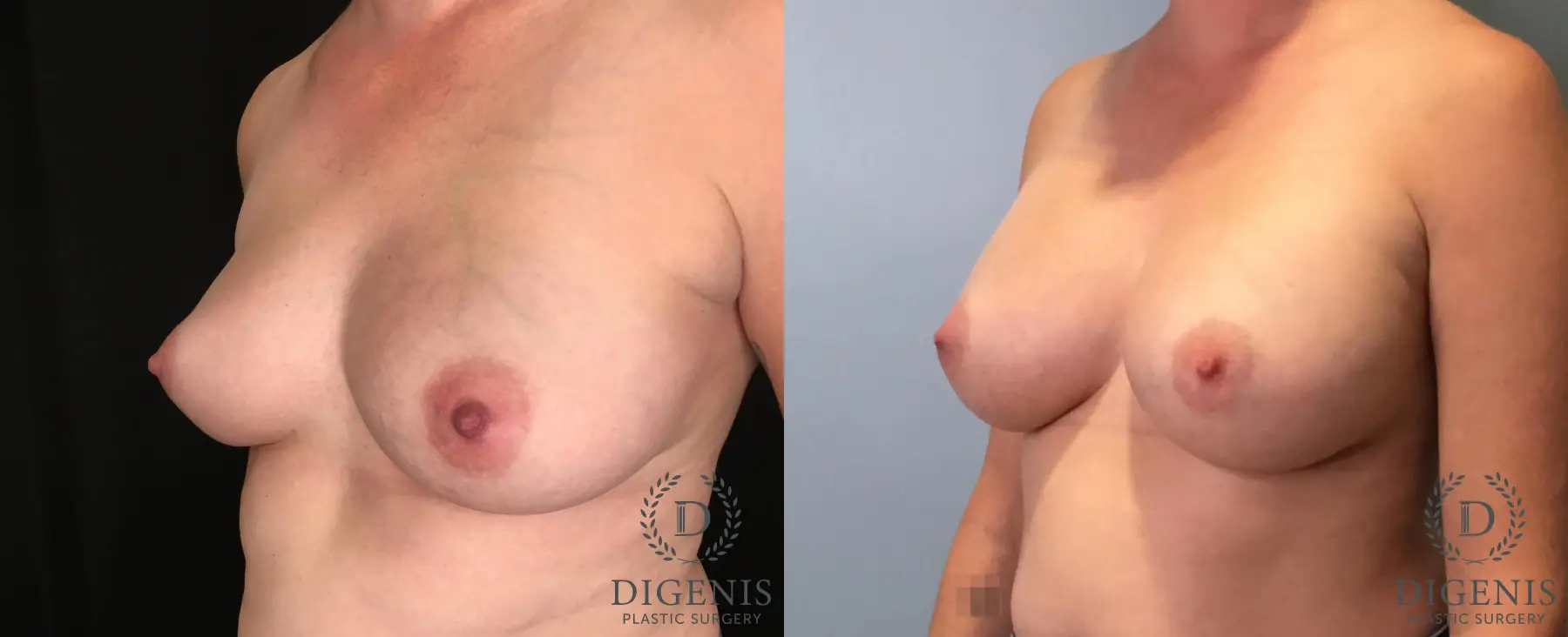 Breast Augmentation: Patient 30 - Before and After 4