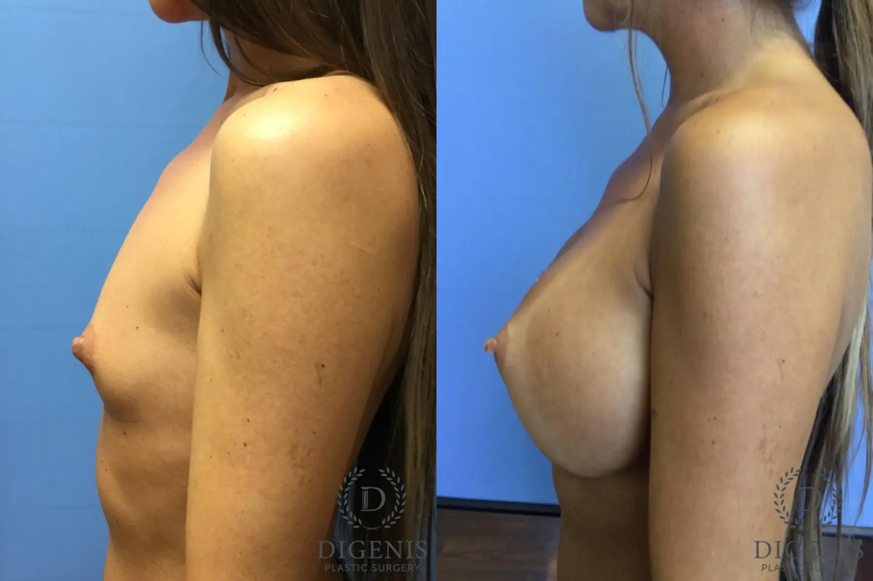 Breast Augmentation: Patient 10 - Before and After 5