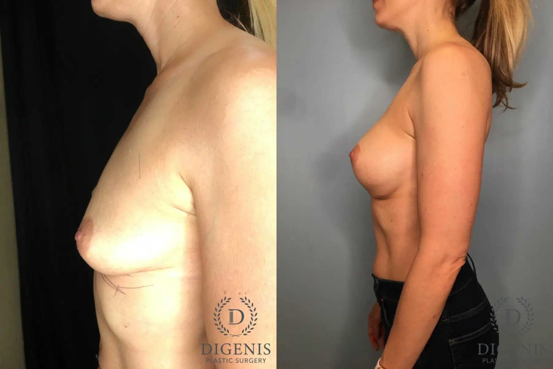 Breast Augmentation: Patient 29 - Before and After 5