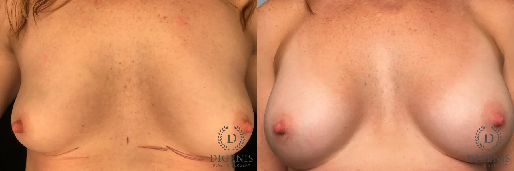 Breast Augmentation: Patient 33 - Before and After  