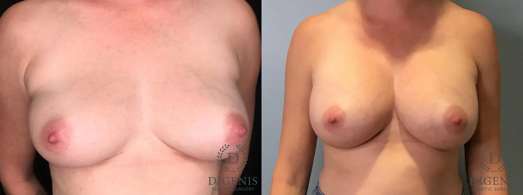 Breast Augmentation: Patient 30 - Before and After 1