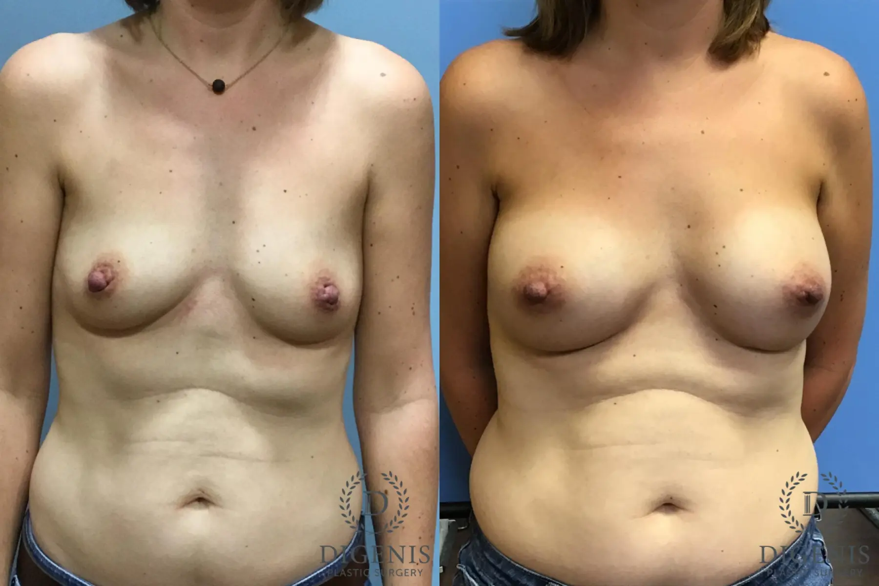 Breast Augmentation: Patient 12 - Before and After  