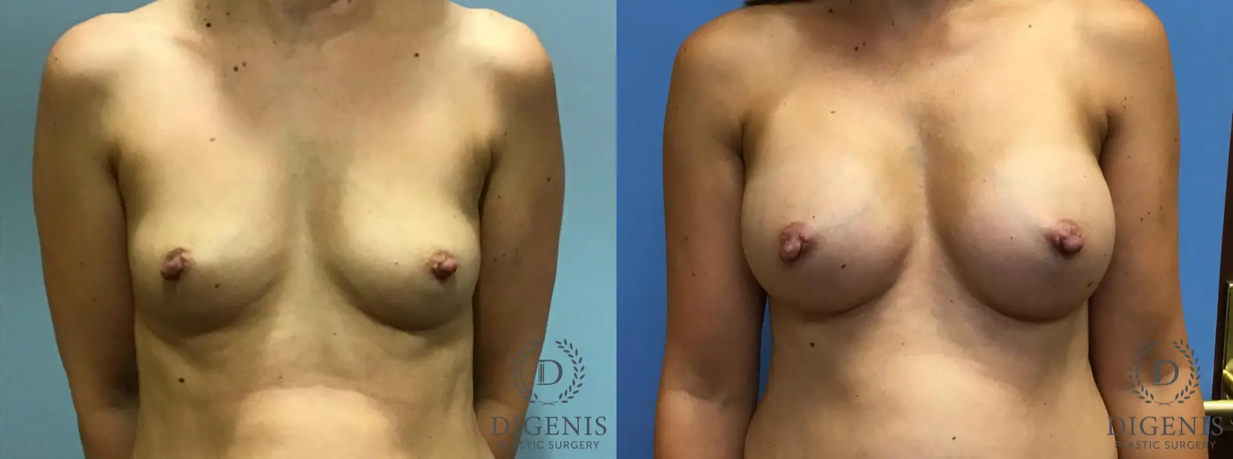 Breast Augmentation: Patient 9 - Before and After  