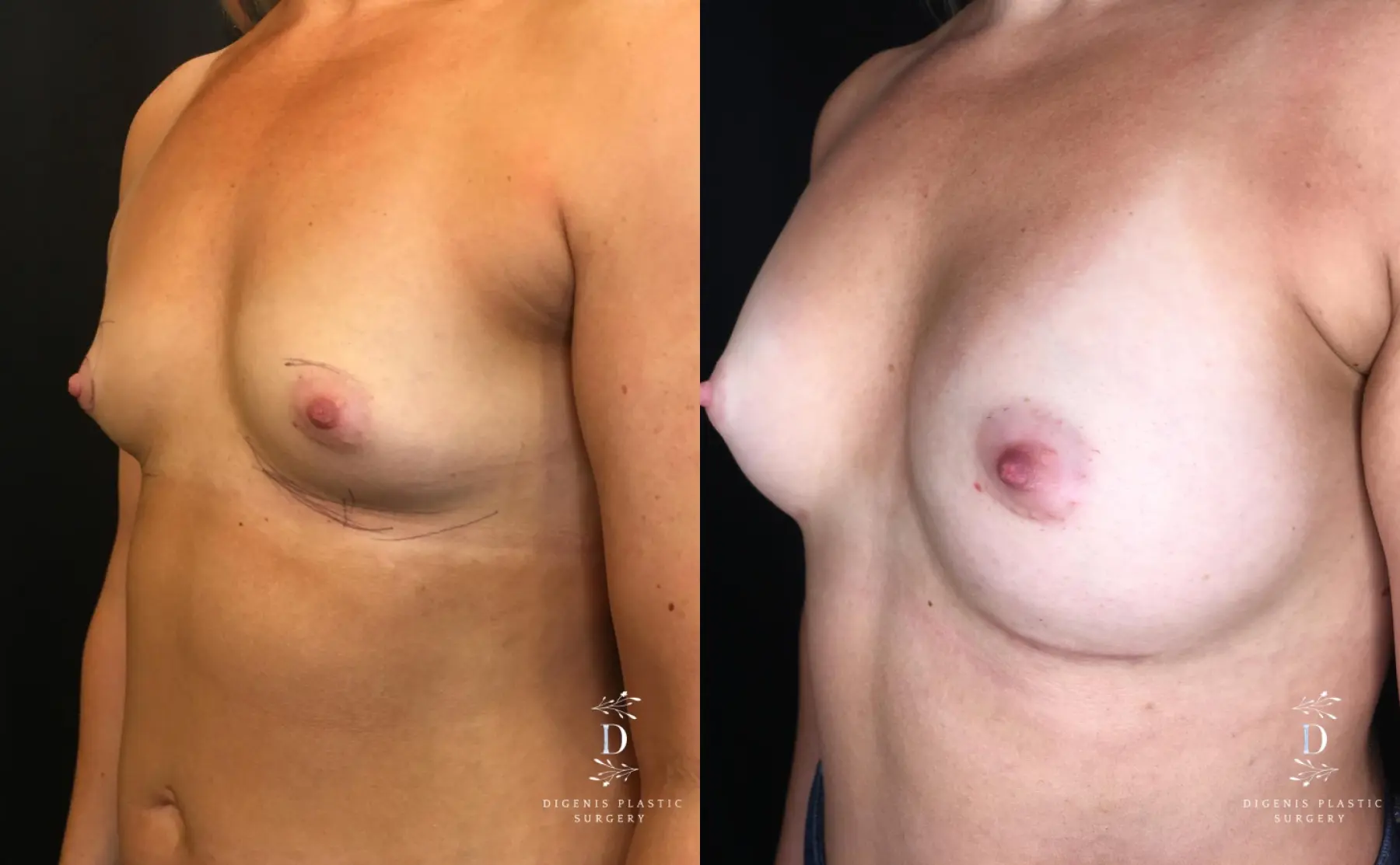 Breast Augmentation: Patient 19 - Before and After 4