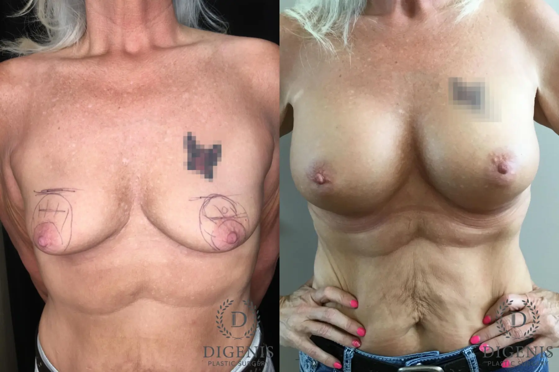 Breast Augmentation: Patient 28 - Before and After  