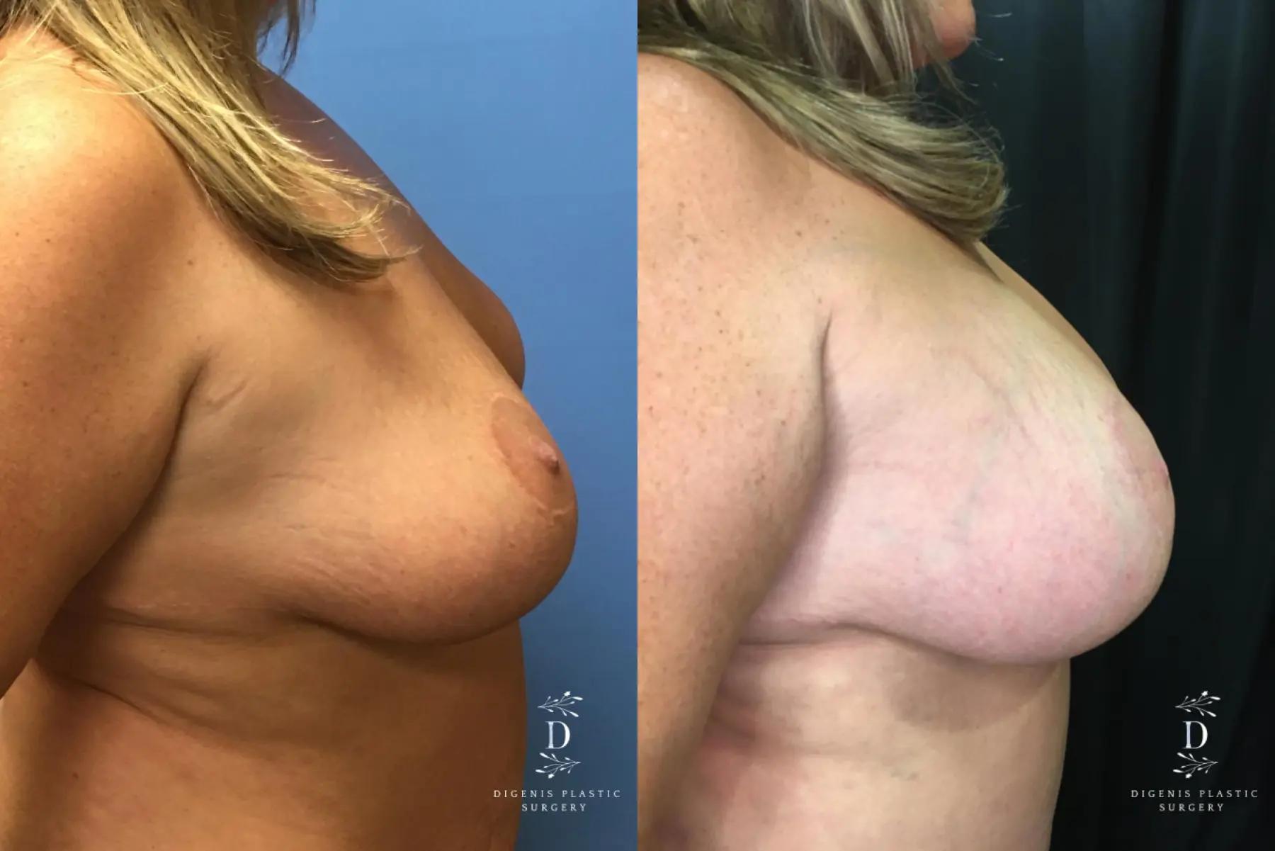 Breast Augmentation: Patient 17 - Before and After 3