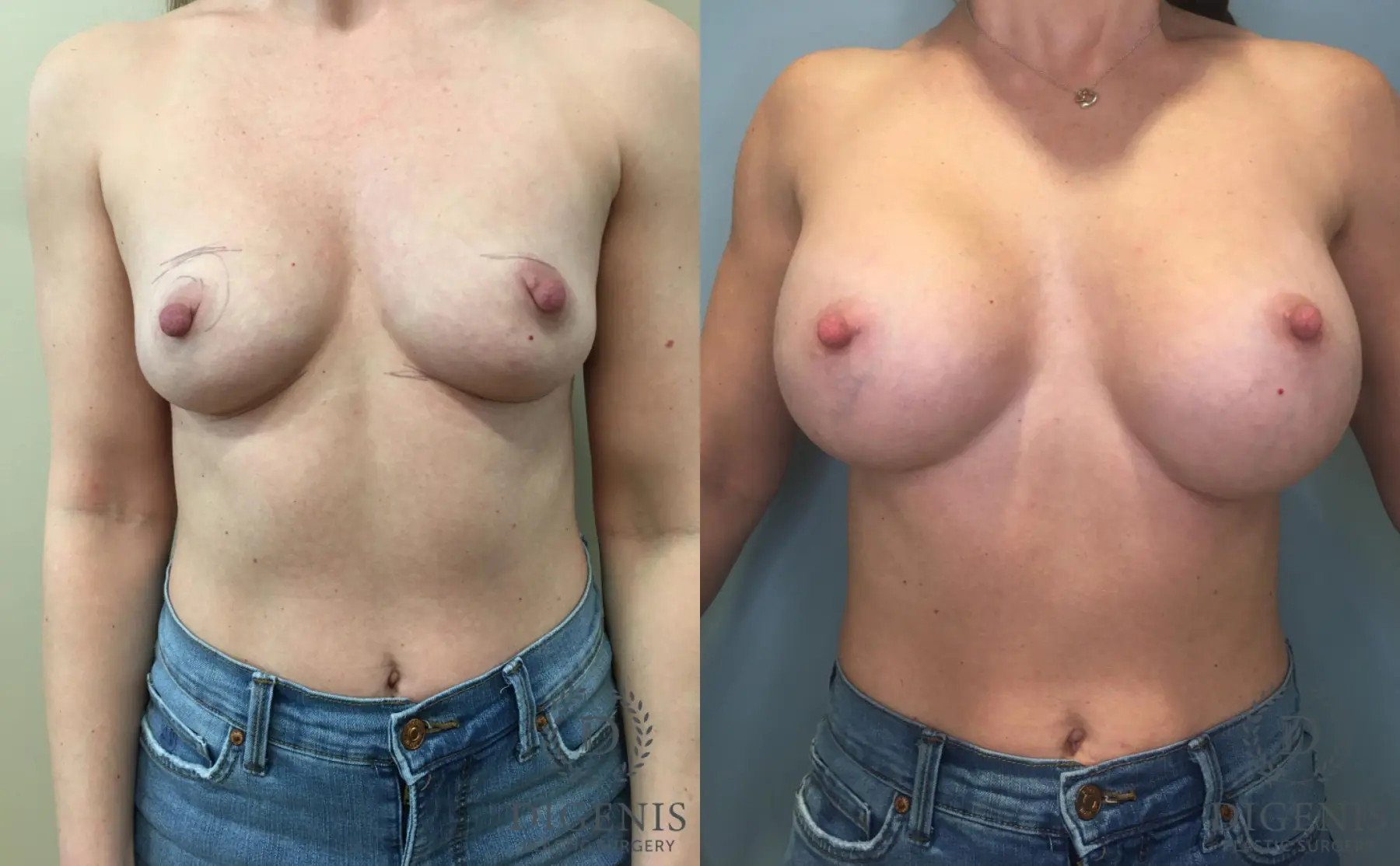 Breast Augmentation: Patient 32 - Before and After 1