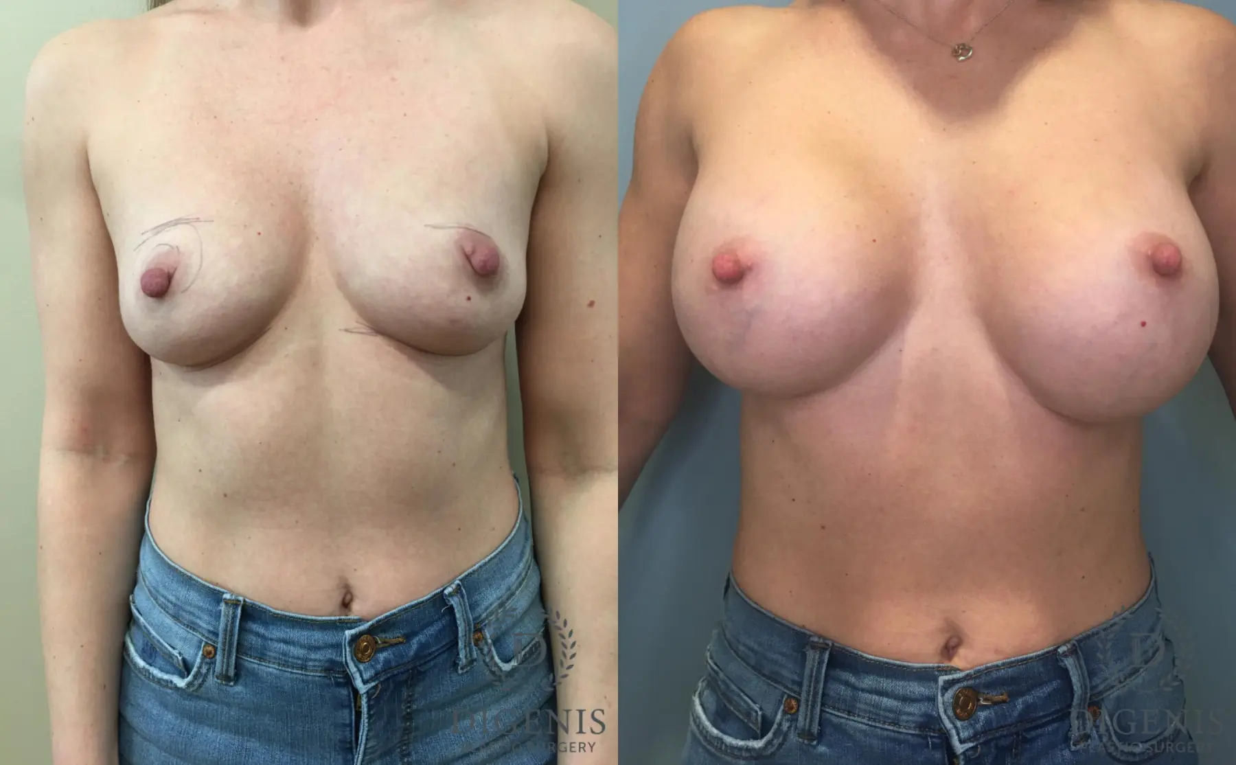 Breast Augmentation: Patient 32 - Before and After  