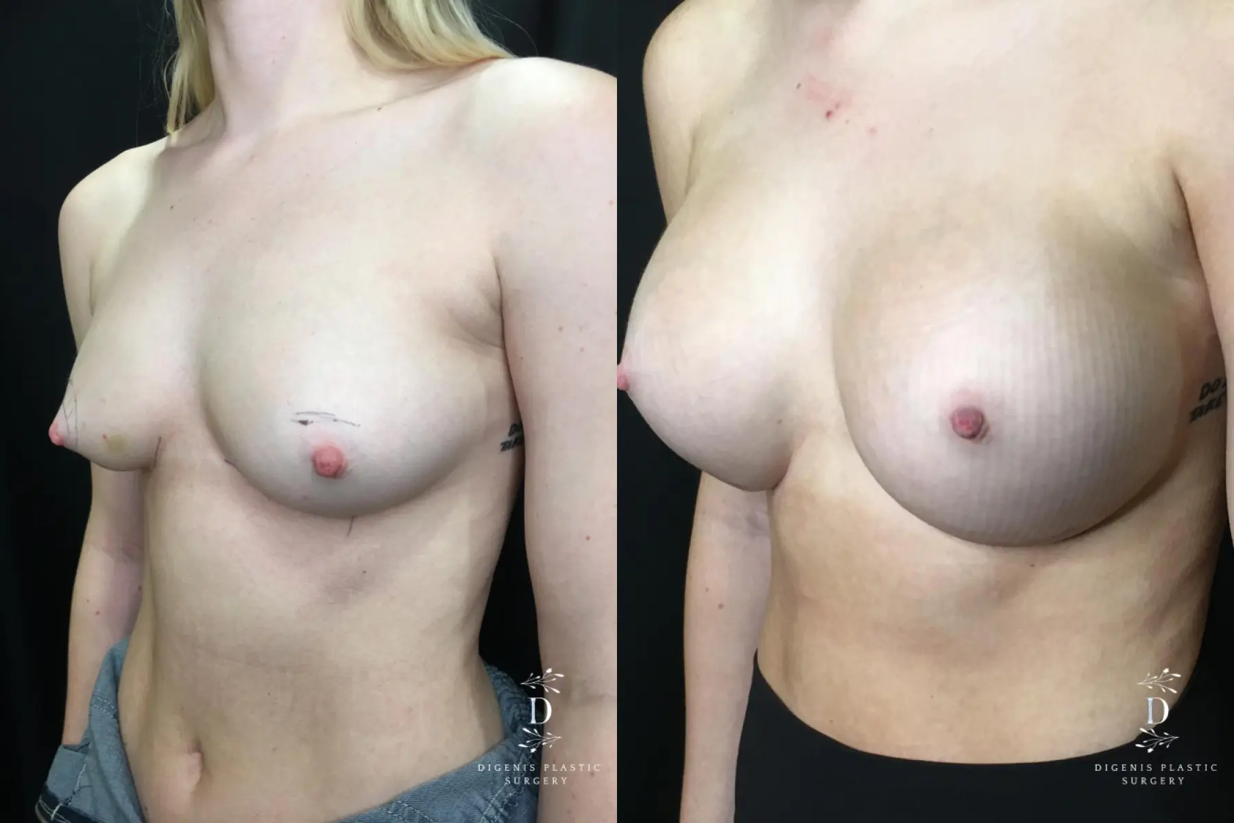 Breast Augmentation: Patient 24 - Before and After 4