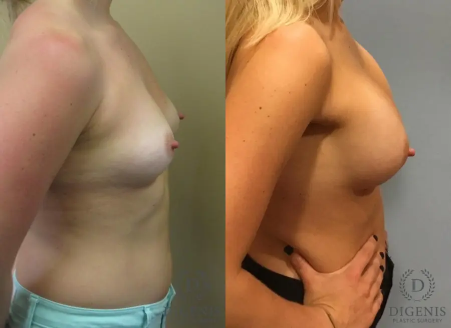 Breast Augmentation: Patient 4 - Before and After 3