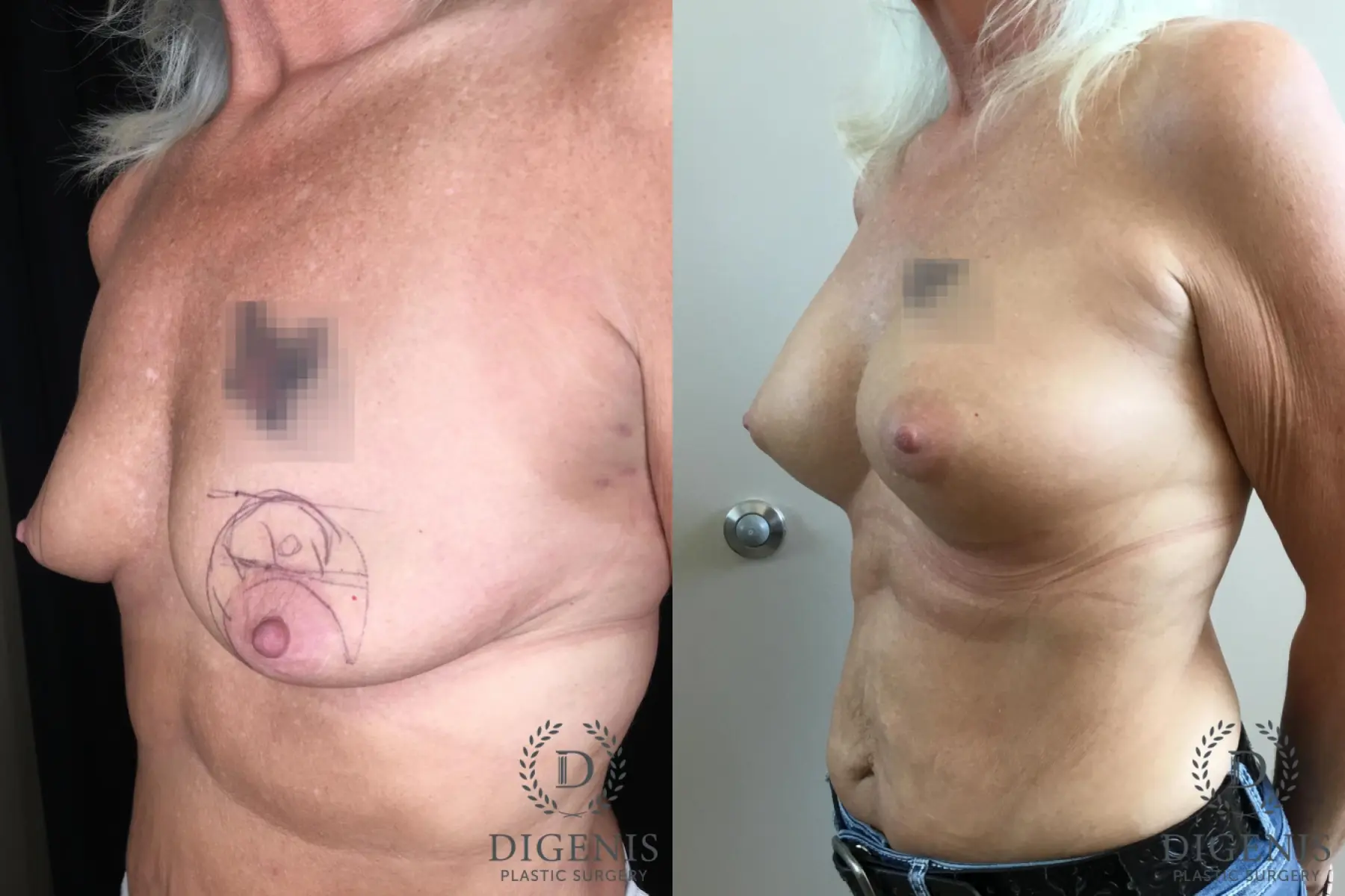 Breast Augmentation: Patient 28 - Before and After 2