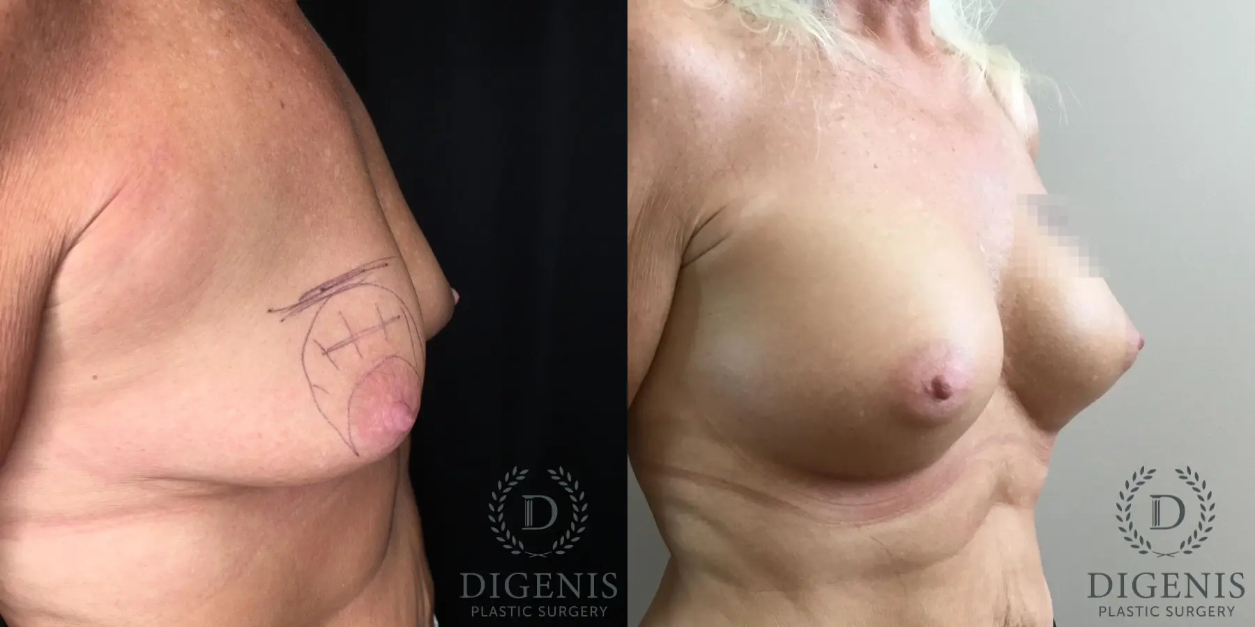 Breast Augmentation: Patient 28 - Before and After 4
