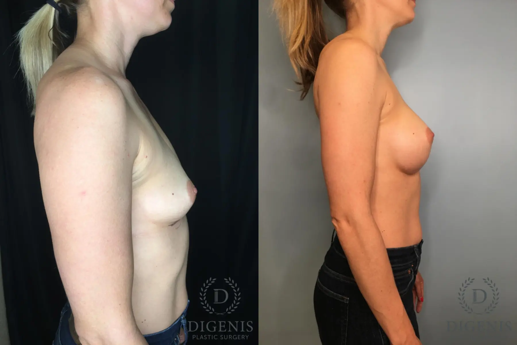 Breast Augmentation: Patient 29 - Before and After 3