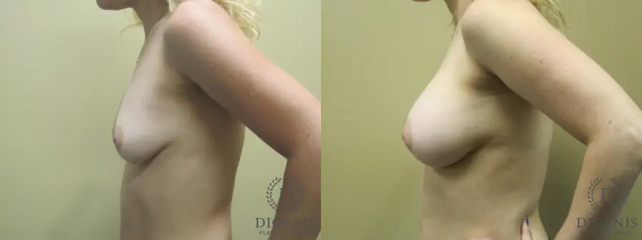 Breast Augmentation: Patient 14 - Before and After 5
