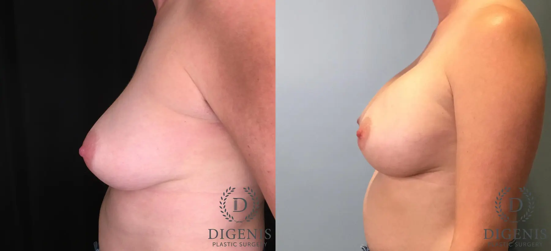 Breast Augmentation: Patient 30 - Before and After 5