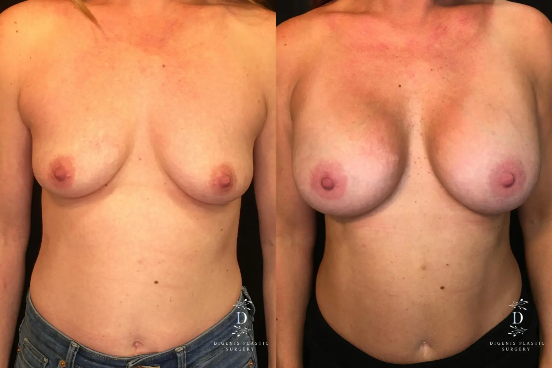 Breast Augmentation: Patient 16 - Before and After  