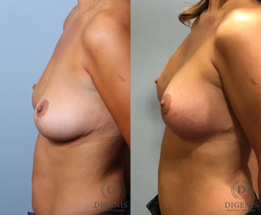 Breast Augmentation: Patient 11 - Before and After 5