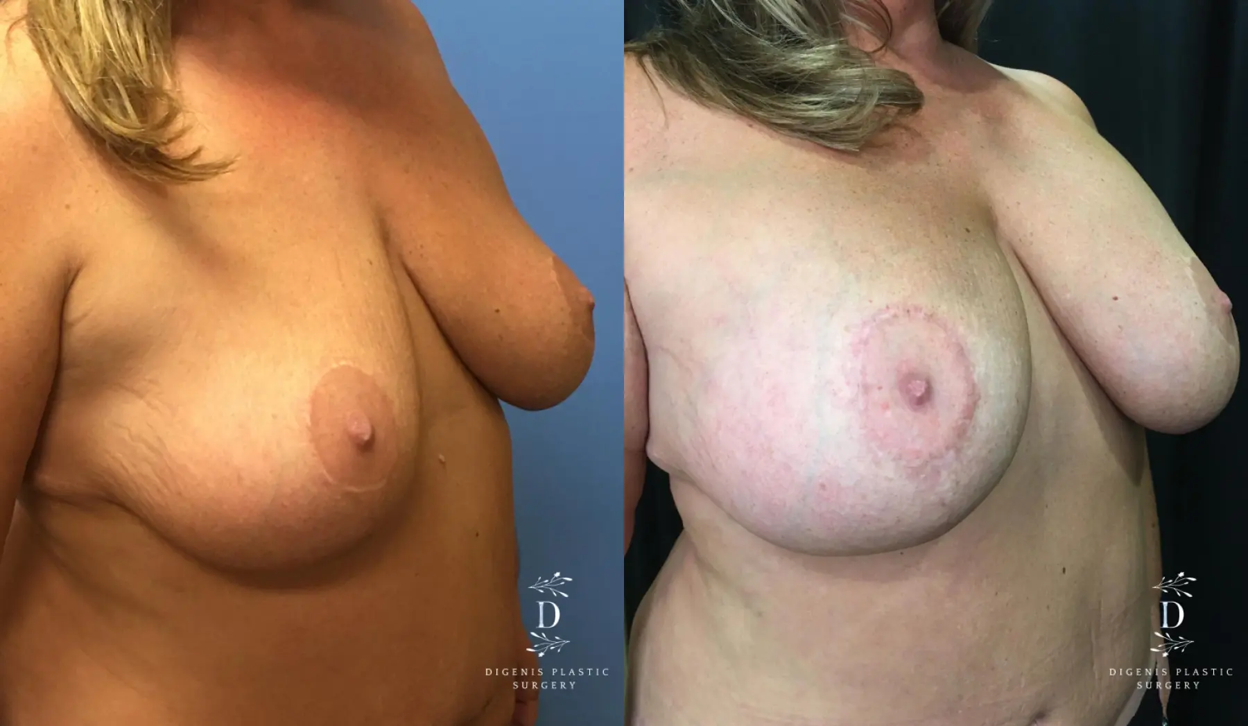 Breast Augmentation: Patient 17 - Before and After 2