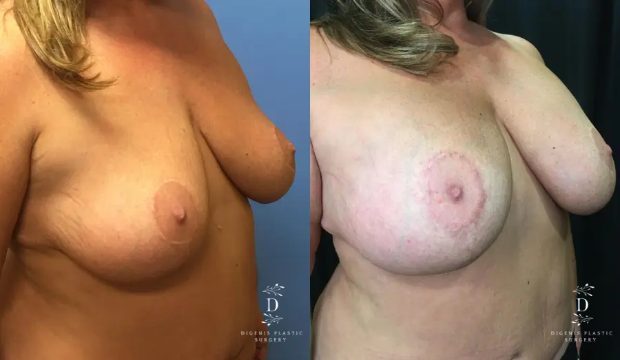 Breast Augmentation: Patient 16 - Before and After 2