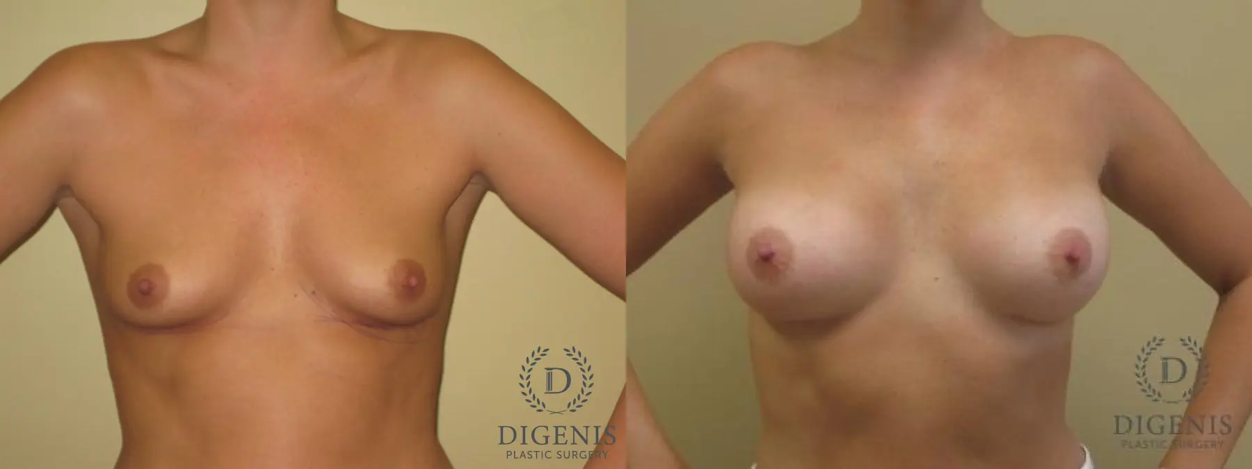 Breast Augmentation: Patient 5 - Before and After 1