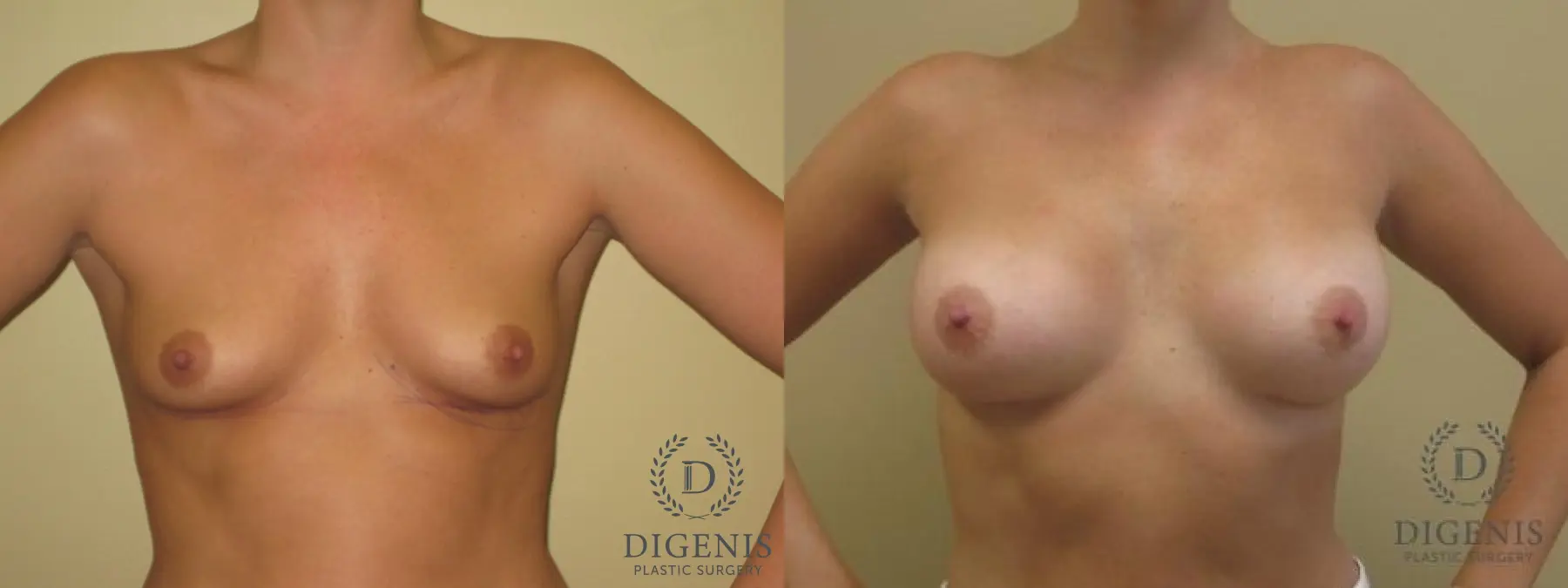 Breast Augmentation: Patient 5 - Before and After  