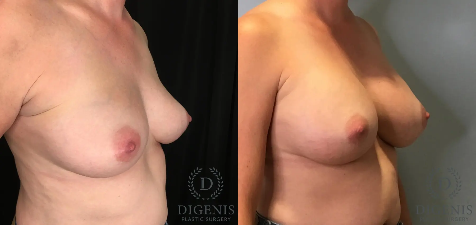 Breast Augmentation: Patient 30 - Before and After 2