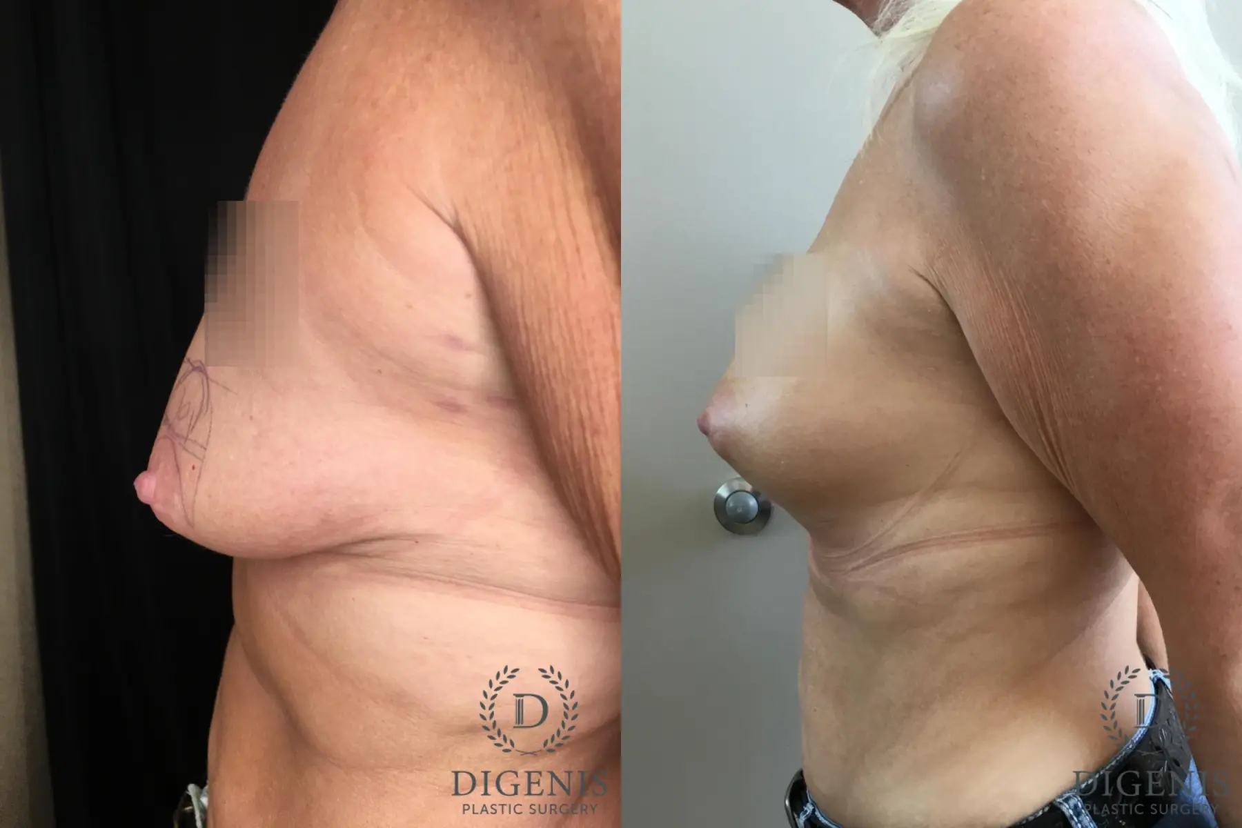 Breast Augmentation: Patient 28 - Before and After 3