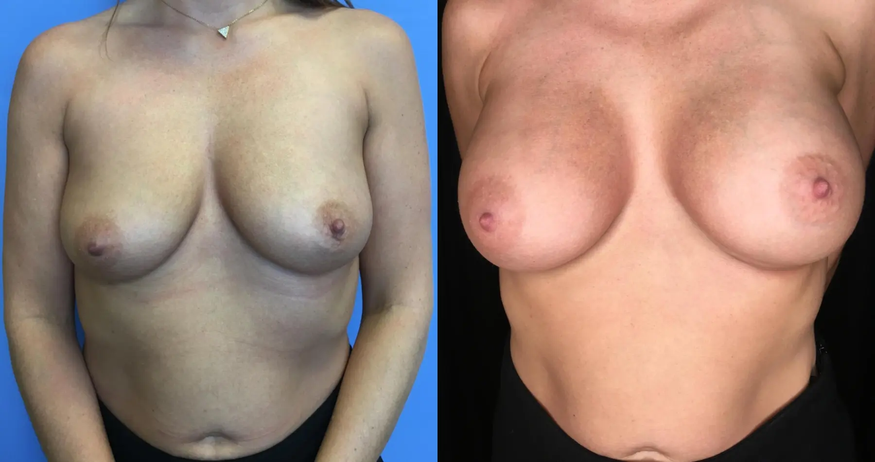Breast Augmentation: Patient 21 - Before and After 1