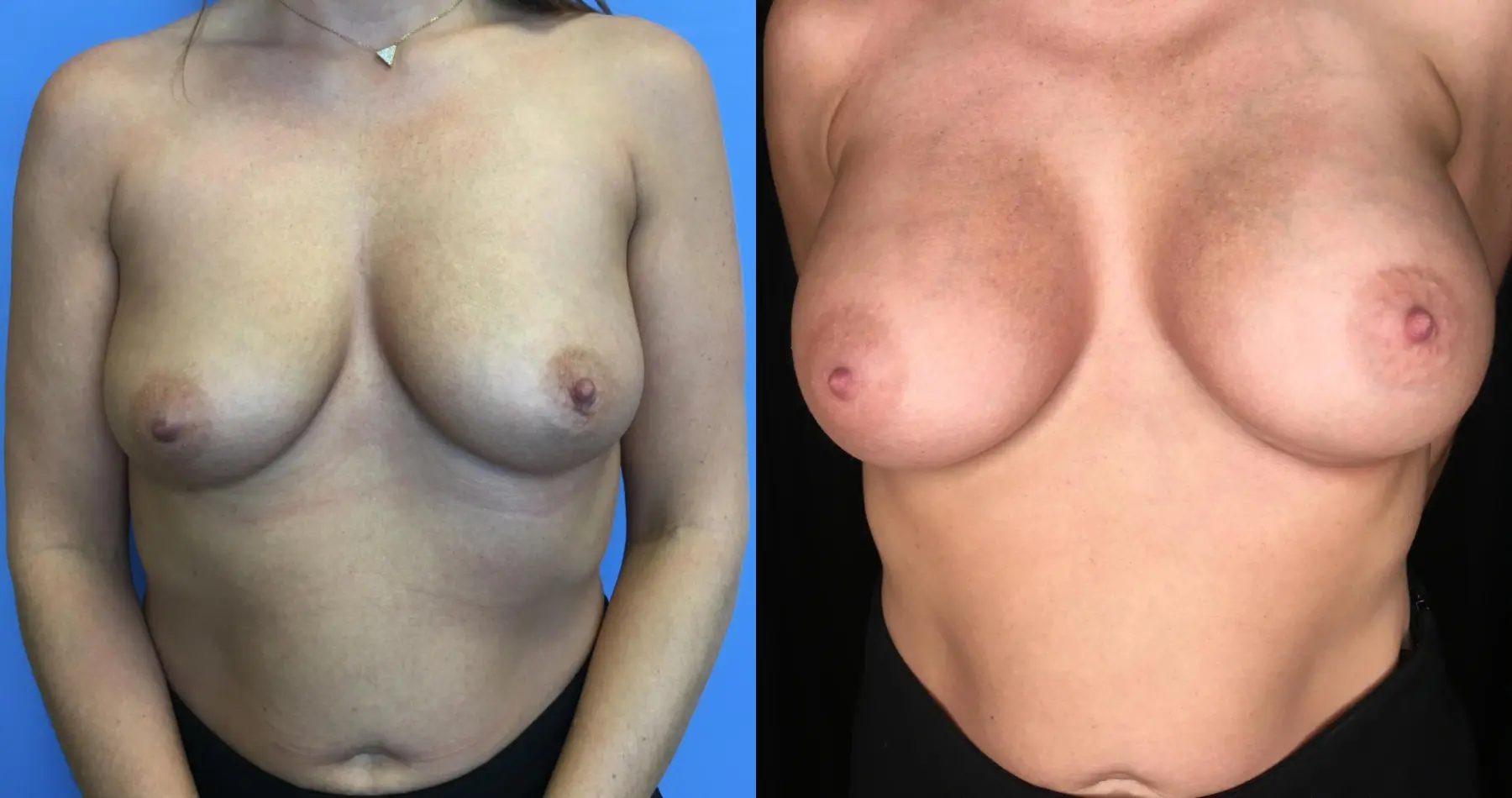 Breast Augmentation: Patient 21 - Before and After  