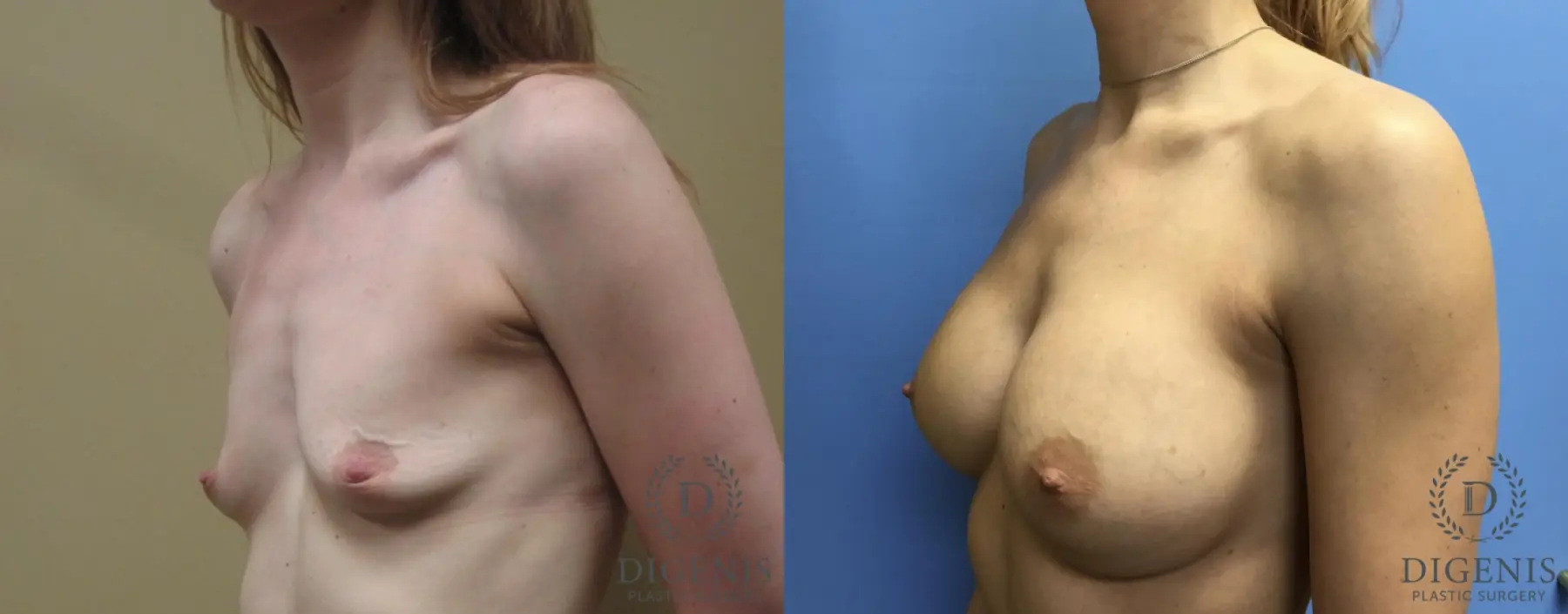 Breast Augmentation: Patient 3 - Before and After 4