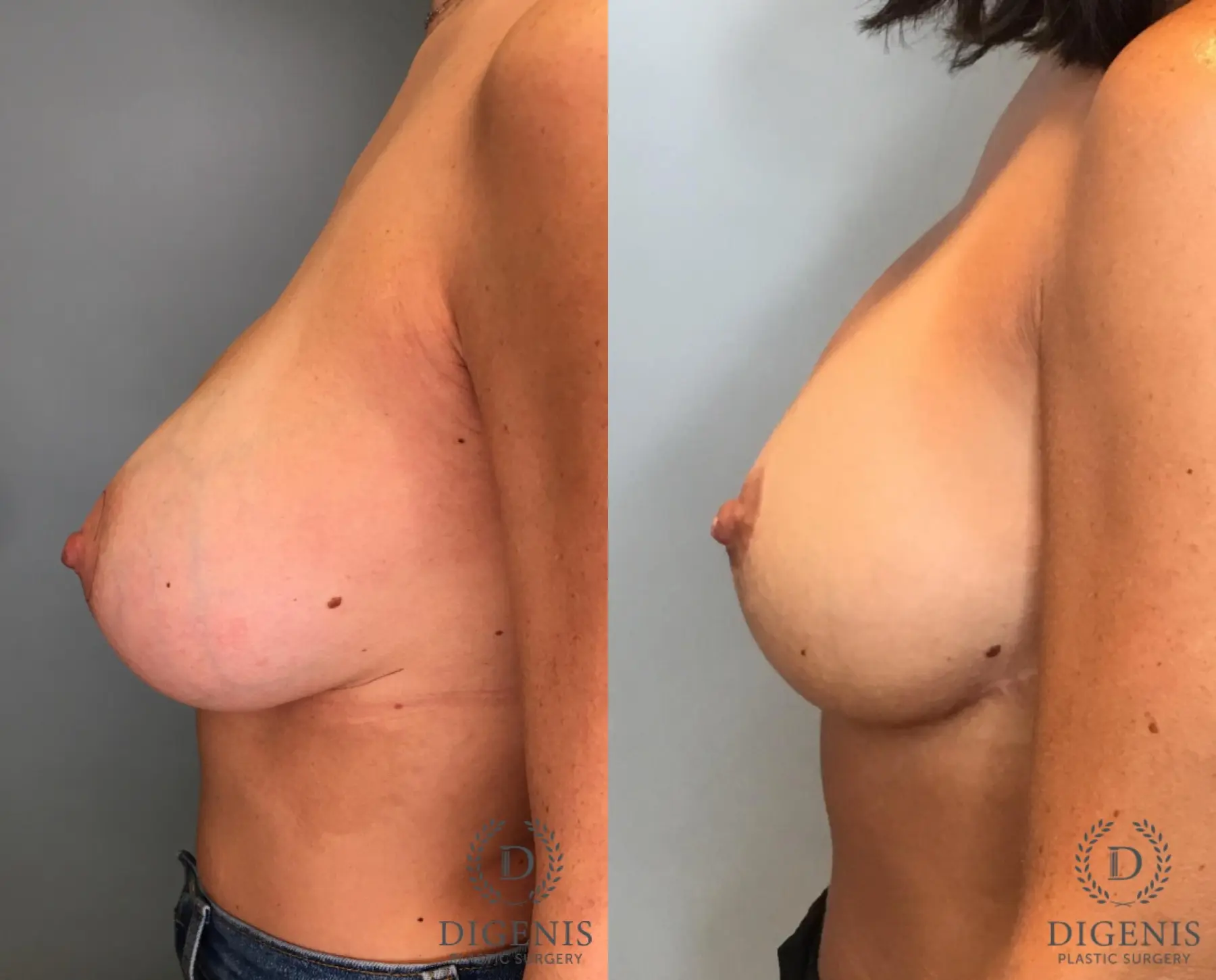 Breast Augmentation: Patient 32 - Before and After 3