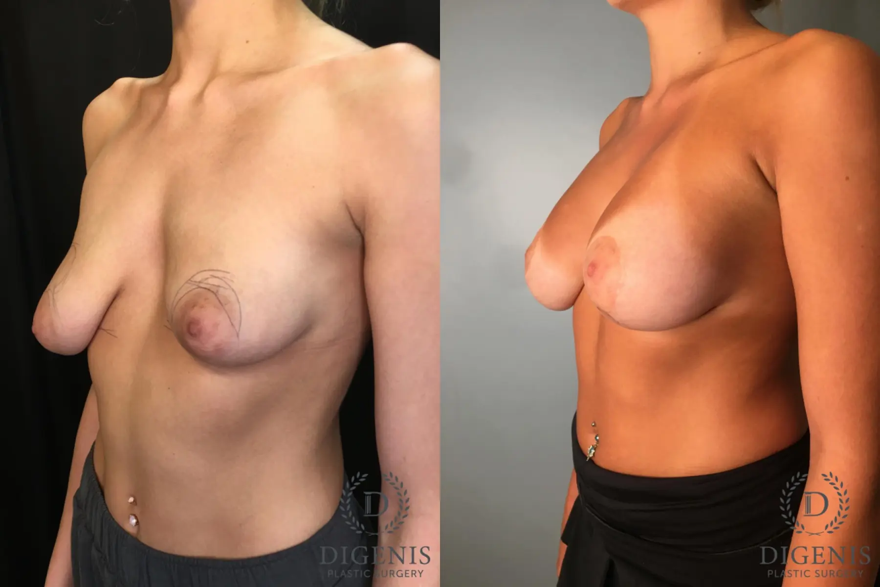 Breast Augmentation: Patient 31 - Before and After 4