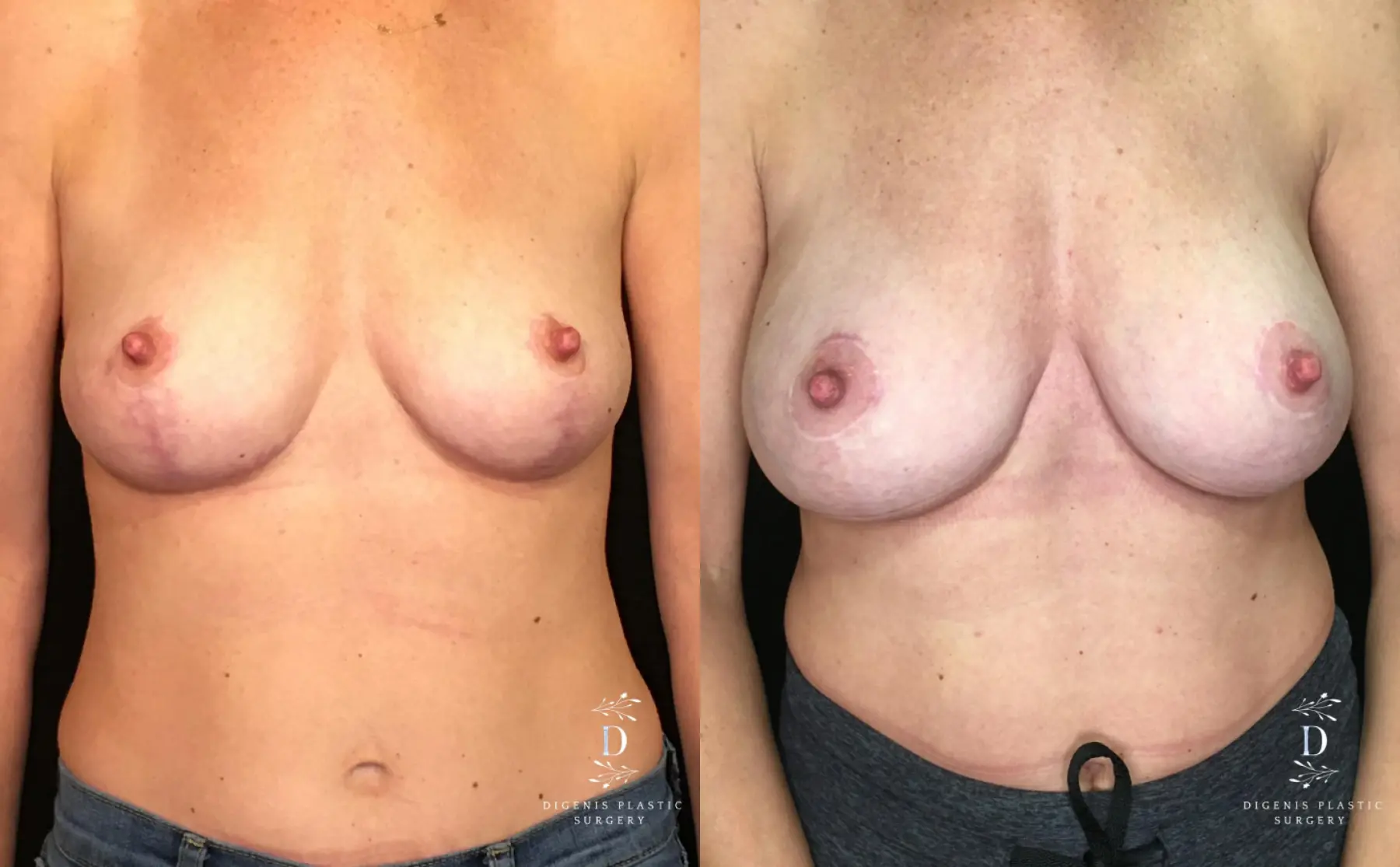 Breast Augmentation: Patient 22 - Before and After 1