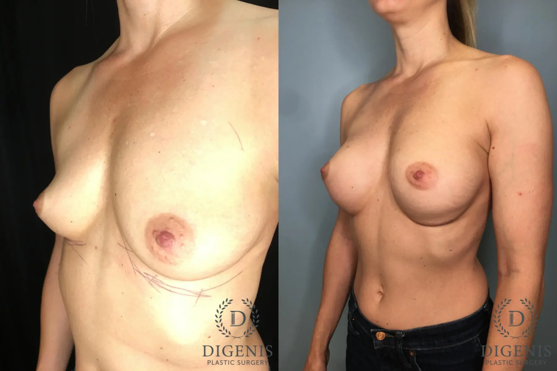 Breast Augmentation: Patient 29 - Before and After 4