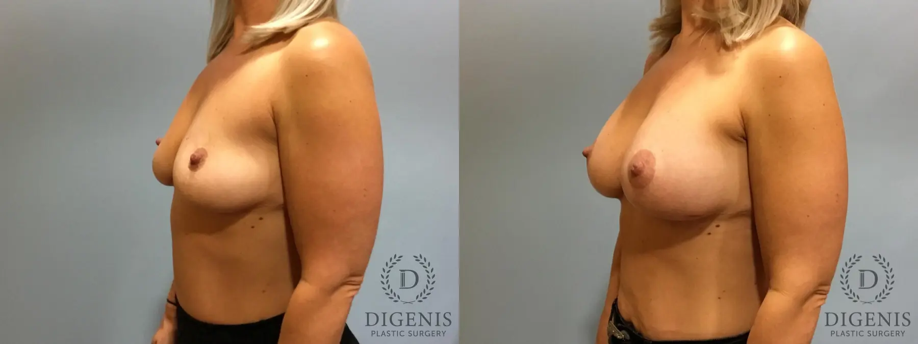 Breast Augmentation: Patient 13 - Before and After 4
