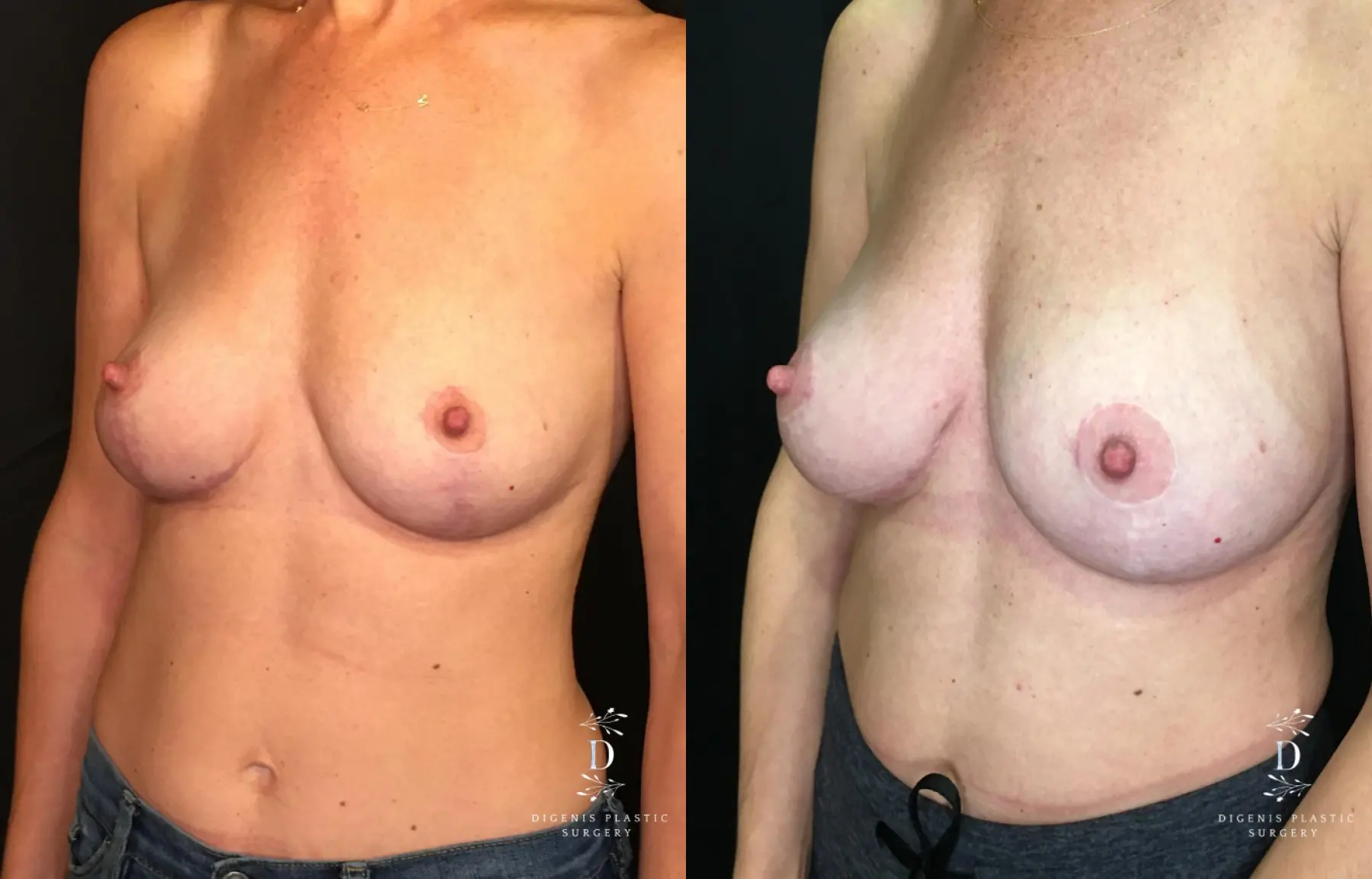 Breast Augmentation: Patient 22 - Before and After 4