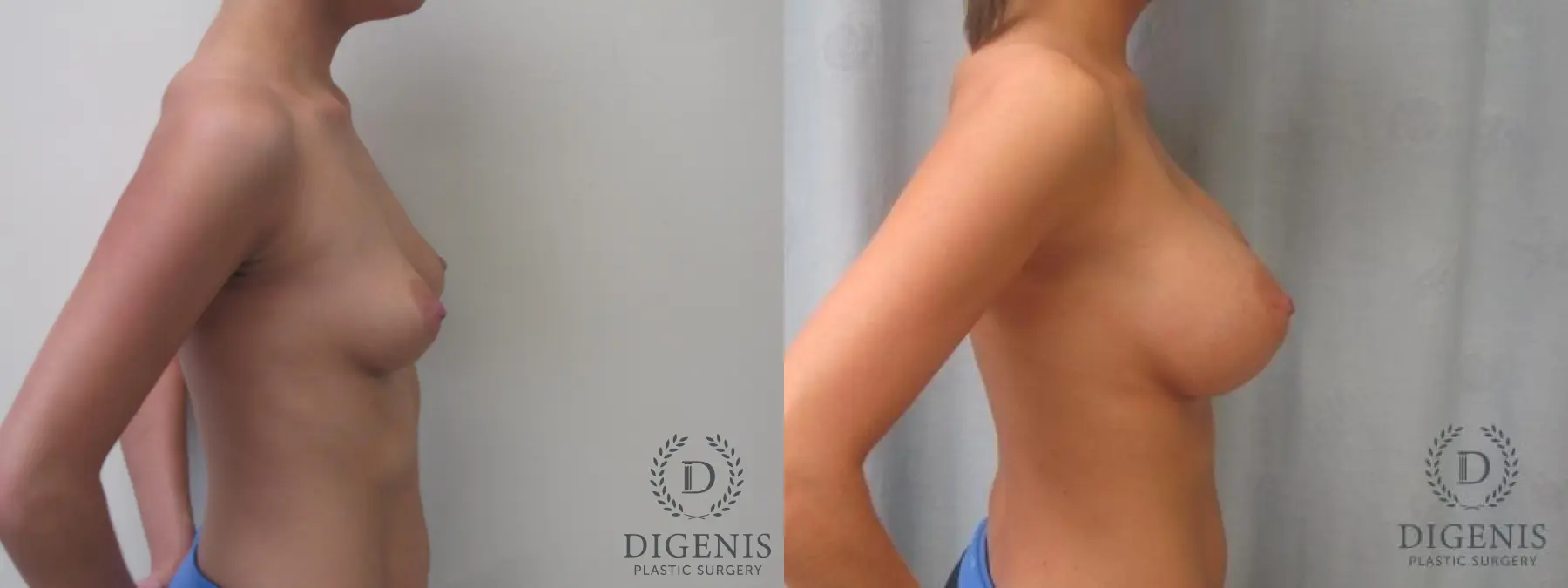 Breast Augmentation: Patient 6 - Before and After 5