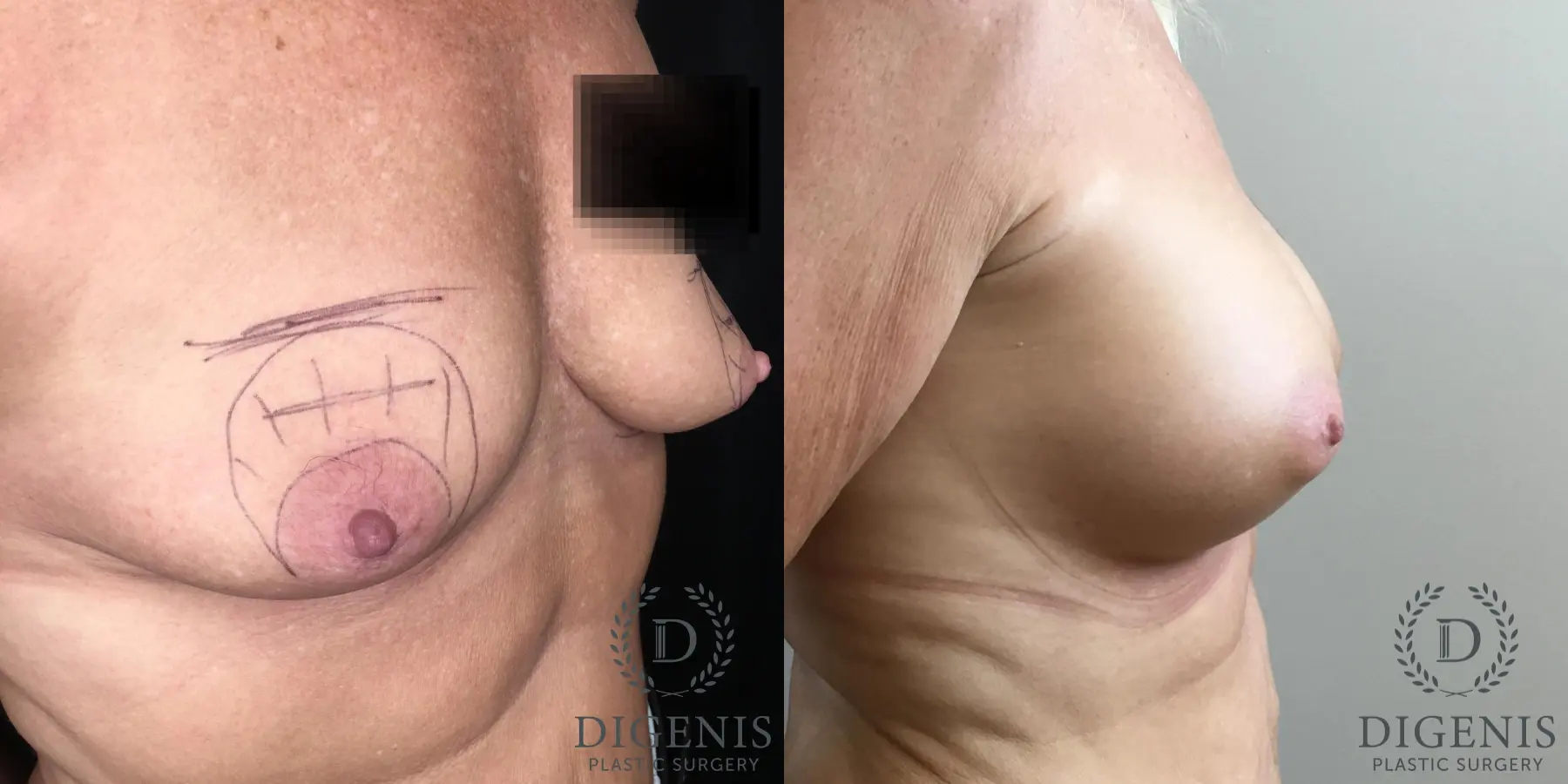 Breast Augmentation: Patient 28 - Before and After 5