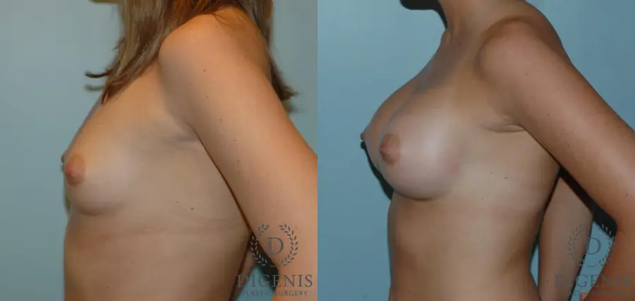 Breast Augmentation: Patient 8 - Before and After 3