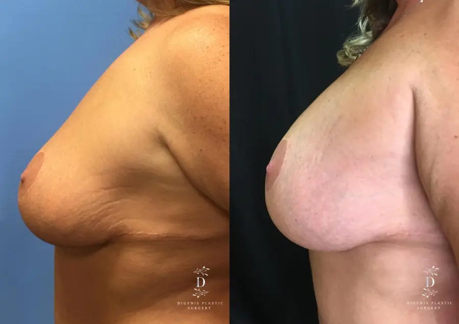 Breast Augmentation: Patient 17 - Before and After 5