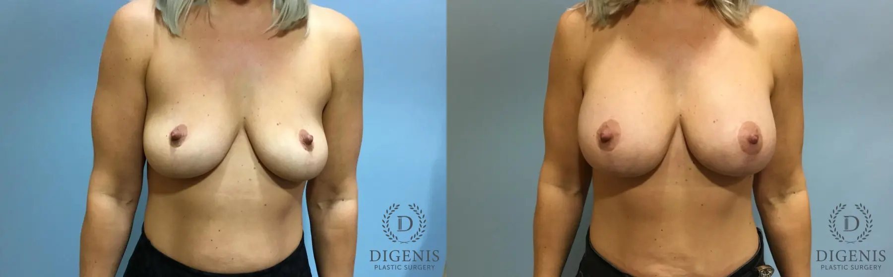 Breast Augmentation: Patient 13 - Before and After  