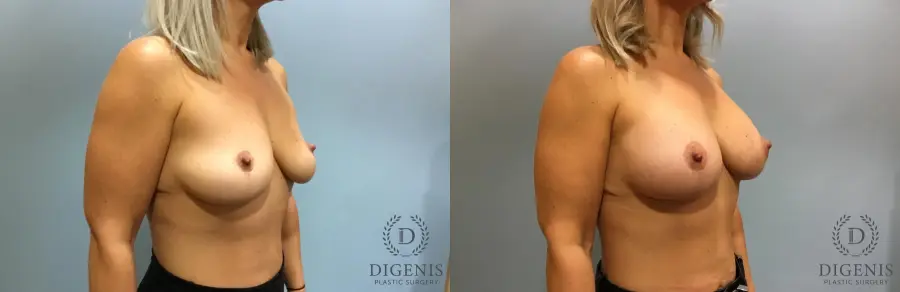 Breast Augmentation: Patient 13 - Before and After 2